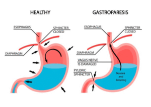 Gastroparesis Symptoms, Diet Tips, and Healing